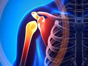 Inflamación de la articulación del hombro debido a artrosis, una enfermedad crónica del sistema musculoesquelético. 