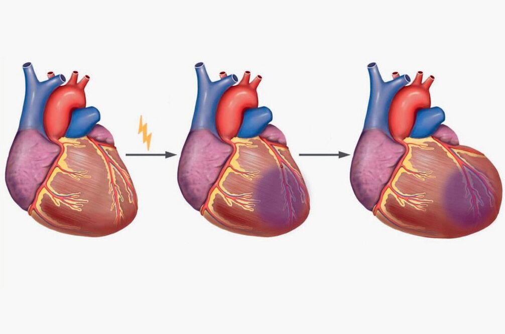 Infarto de miocardio que causa dolor en el omóplato