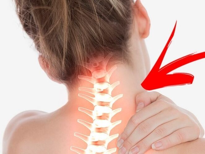 Compresión degenerativa de raíces nerviosas con cartílago óseo cervical