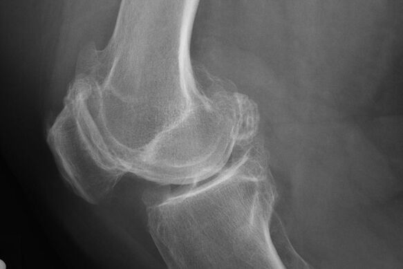 Métodos para diagnosticar las articulaciones de la rodilla