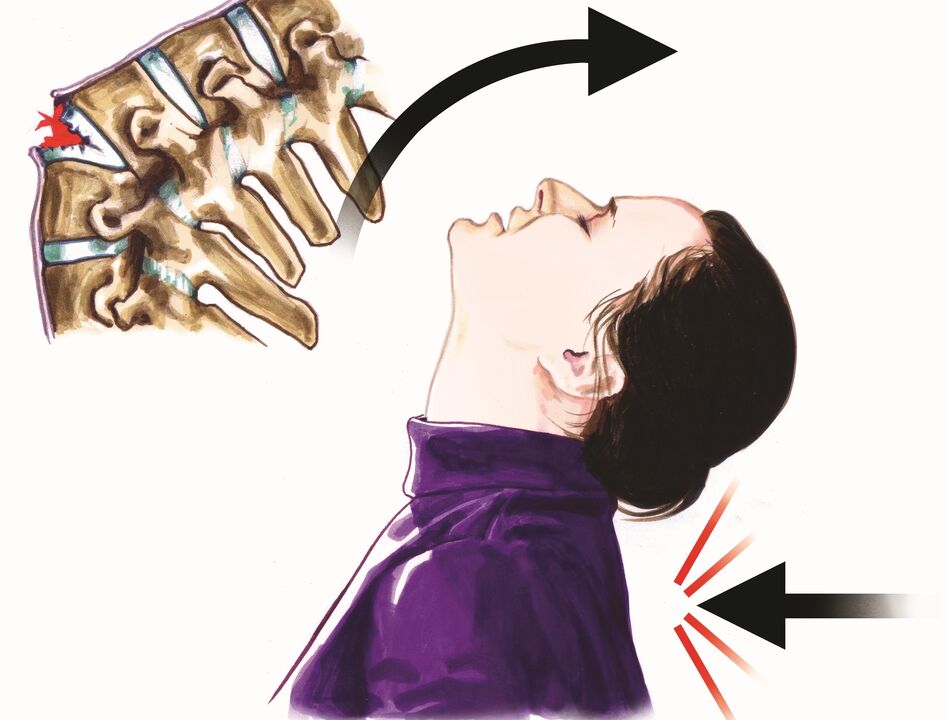 La lesión de la columna es una causa de dolor de cuello.