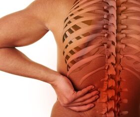 Dolor lumbar con osteocondrosis lumbar.