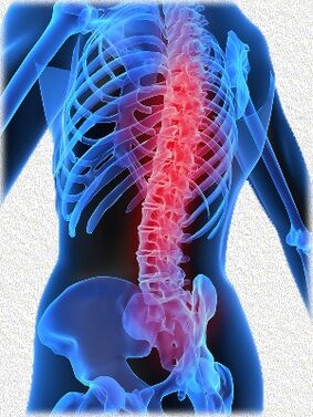 Osteocondrosis y su tratamiento.