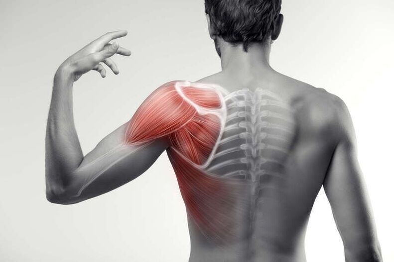 zonas de dolor muscular
