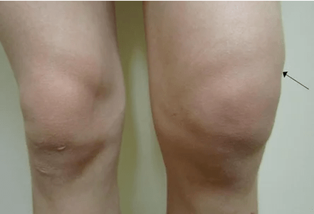 Hemorartritis de rodilla