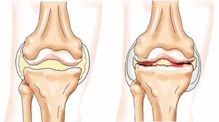 condromatosis
